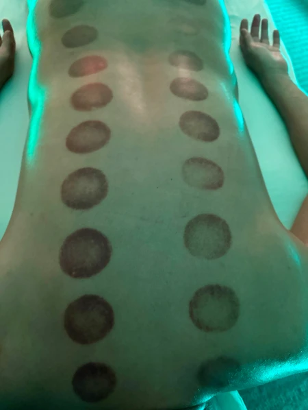 cupping